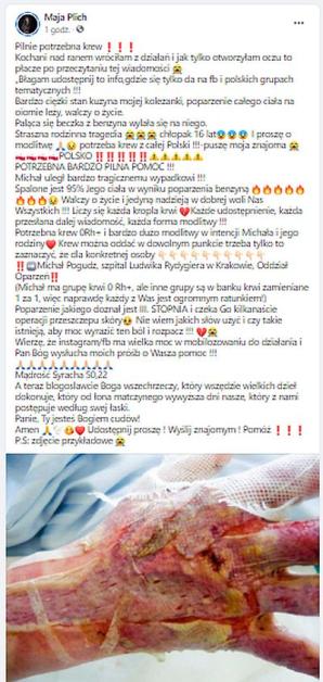 Koszmarne poparzenie 16-letniego Michała w przydomowym garażu w Zamościu! Maja Rutkowski apeluje o natychmiastowe oddawanie krwi 0 RH+ !!!